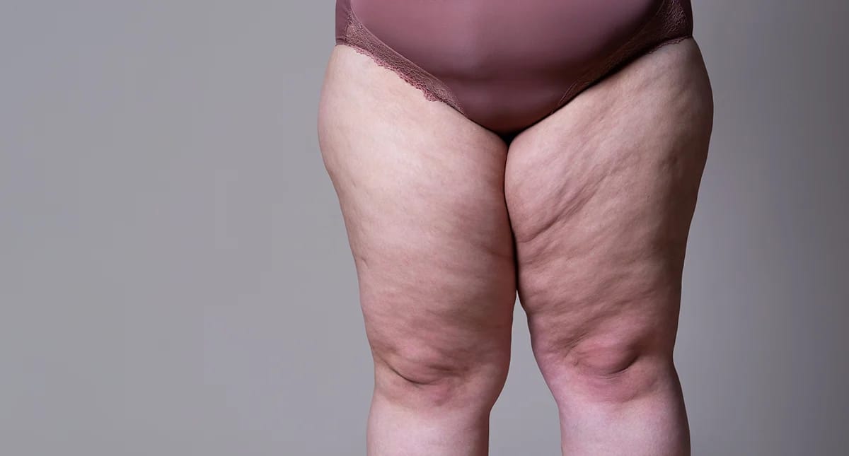 Lipödem erkennen: Betroffene berichten über ihre Erfahrungen